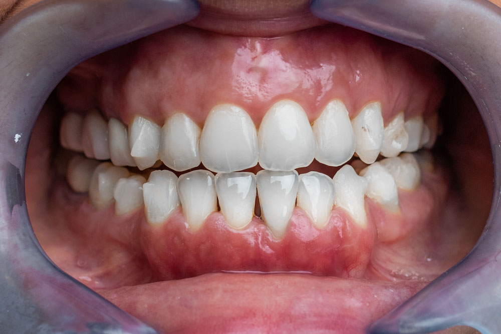 Invisalign®